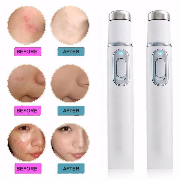 Blue Light Therapy Acne Pen LED Face Light Therapy For Scar Wrinkle Removal Treatment Device Skin Care Beauty Equipment